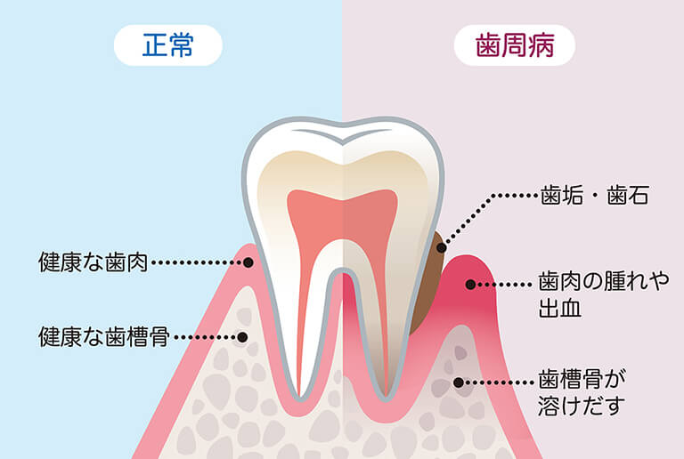 歯周病の説明