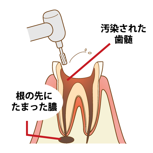 切削器具を用いてむし歯や被せ物を除去